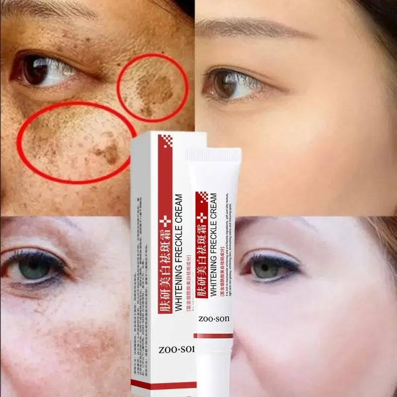 Effective Whitening Cream Remove Dark Spots Anti Fade Pigmentation Creams Skin Care